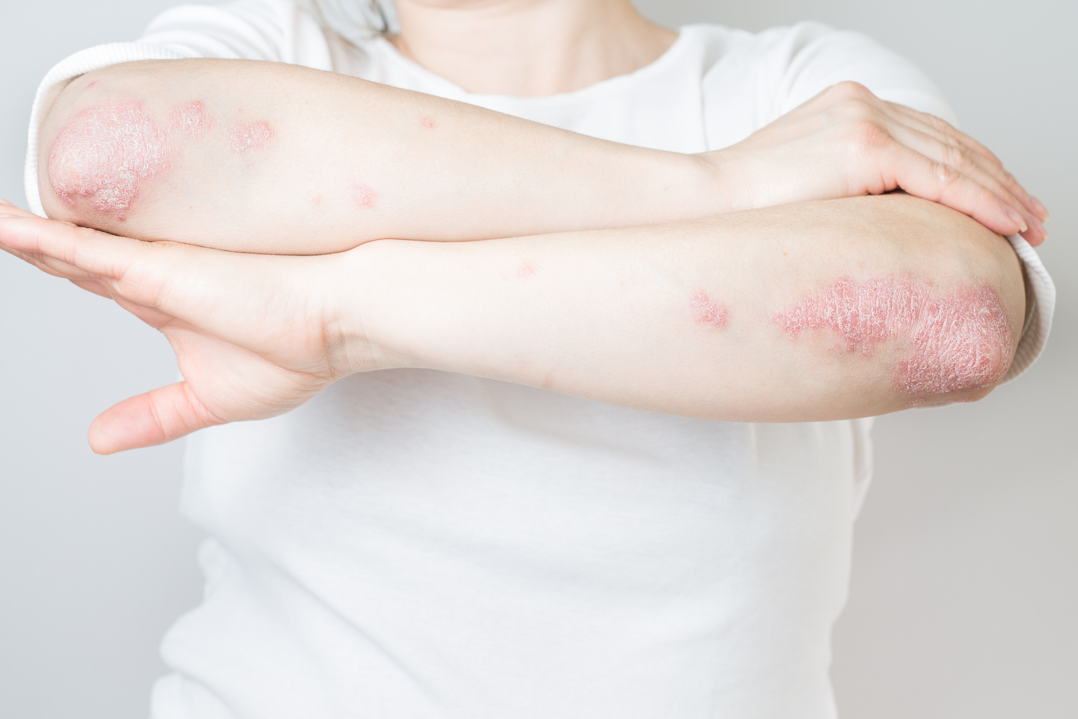 Home remedies related to eczema in Amritsar